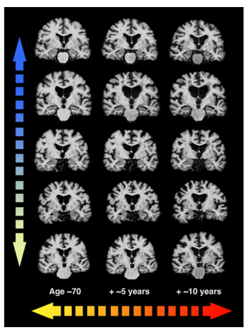 Scan av fem hjerner over 10 år
