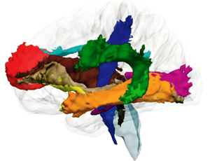 Scan av en hjerne. Flere områder er markert i ulike farger.