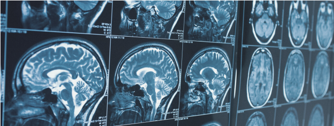 Image may contain: Medical imaging, Radiology, Computed tomography, Brain, Radiography.